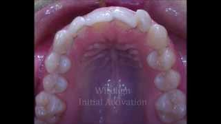 Wirelign® Orthodontics Invisible And Comfortable Way To Straighten Teeth [upl. by Rochelle]