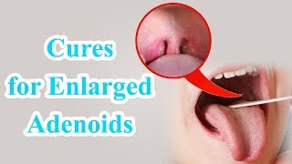 Natural Remedies and Natural Treatment for Enlarged Adenoids in Children  Health Benefits [upl. by Veron]