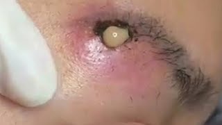 Big Cystic Acne Blackheads Extraction Blackheads amp Milia Whiteheads Removal Pimple Popping 099 [upl. by Landbert]