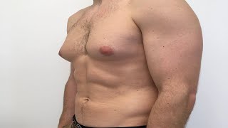 how to get rid of gynecomastia fast without surgery [upl. by Aurita]