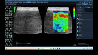 IQ 281 HEPATOMA ECHOPAC ANALYSIS ULTRASOUND ELASTOGRAPHY [upl. by Elin]