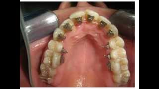 lingual Orthodontic Treatment Orthodontist [upl. by Niatsirt]