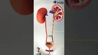 How much size kidney stone normally pass kidney stone Treatment [upl. by Ardnait317]