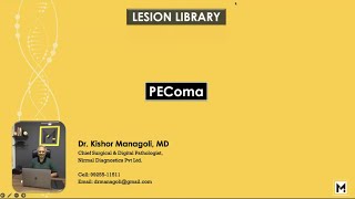 Pathology of PEComa [upl. by Gosselin]