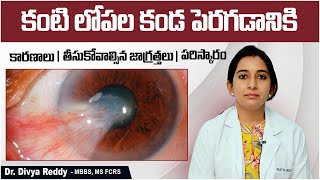 కంటిలో కండకు  Pterygium Causes and Treatment  Eye Care Tips In Telugu  Best Vision Eye Hospital [upl. by Bartlett]