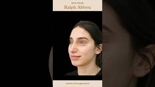 Résultat après rhinoplastie ultrasonique par Dr Abbou [upl. by Eirek]