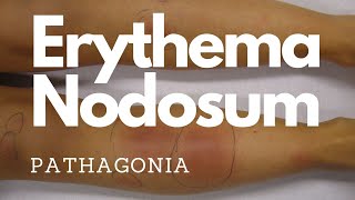 Erythema Nodosum pathagonia [upl. by Barney101]