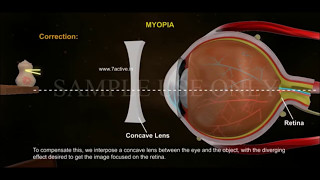 Contact Lenses  Silicone Hydrogel [upl. by Candy]