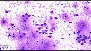 Cytology Thyroid nodule FNA  Metastatic breast carcinoma [upl. by Elyr]