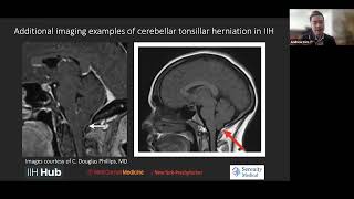 Cerebellar Tonsillar Herniation in Idiopathic Intracranial Hypertension IIH with Andrew Kim MD [upl. by Jacobba]