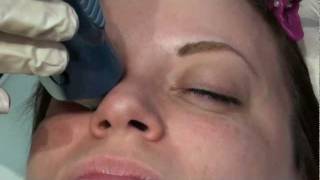 Does Thermage Skin Tightening Laser Treatment hurt [upl. by Anita]