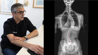 Severe Scoliosis Evaluation amp Treatment DrRahim Chiropractic [upl. by Akel]