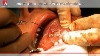 HEMANGIOMA REMOVAL Fotona Lightwalker NdYAG laser [upl. by Shaya]