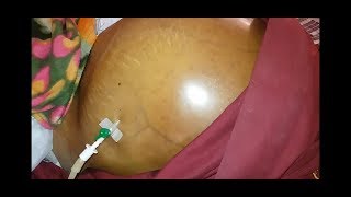 Ascites Fluid Tapping Procedure  Percentesis [upl. by Inal]