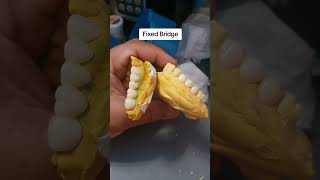 Fixed Bridge Zirconia [upl. by Iila]