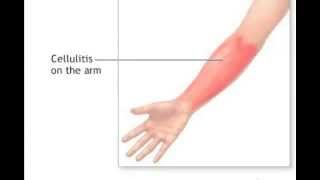 What Is Cellulitis [upl. by Eirojram]