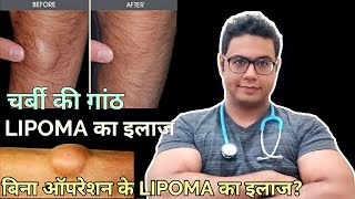 Doctor Explains Lipoma  Treatment without surgery and with surgery । LIPOMA का इलाज बिना ऑपरेशन के [upl. by Essam]