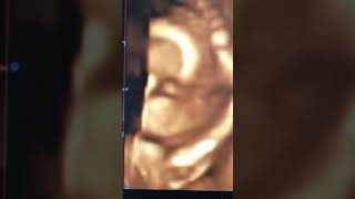 3D Ultraschall von Baby im Mutterleib [upl. by Neeluqcaj]