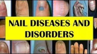 Nail Diseases and Treatment [upl. by Inol]