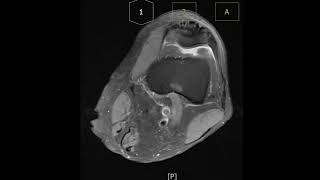 Prepatella bursitis with bursal wall thickening [upl. by Maitilde]