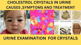 CHOLESTROL CRYSTAL IN URINECAUSES SYMPTOMS AND TREATMENT OF CHOLESTROL CRYSTALS URINARY CRYSTAL [upl. by Pepita236]