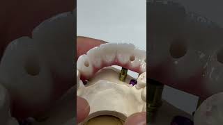 6 unit bridge from 3 implants [upl. by Ryhpez]