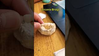 Zirconia Bridge  Cosmetic Smile Design 😃  Smile makeover  Hollywood Smile  Dentist in Nepal [upl. by Stephen98]