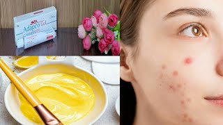 How to get rid of Acne  My acne journey [upl. by Kassel]