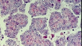 Thyroid Neoplasms  Pathology mini tutorial [upl. by Nnyleuqaj]