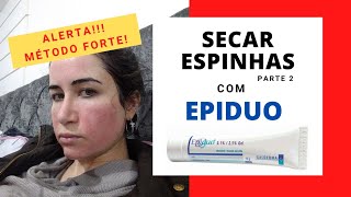 Como secar espinhas  FORTE  com Epiduo [upl. by Silverman]