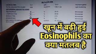 Eosinophils high in blood test means eosinophilia High Eosinophils cbc Blood test in hindi [upl. by Ricarda971]