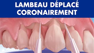 Lambeau déplacé coronairement  Récession gingivale traitement © [upl. by Rosalyn897]