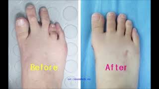 brachydactyly brachydactylysurgery 短指症手術 短指症 단지증 단지증수술 단지증수술후기 عضدي الأصابع брахидактилия [upl. by Nosae769]