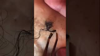 Removal of ingrown hair [upl. by Ansilma]