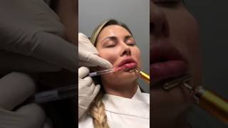 Restylane Refyne for Lip Enhancement  Painless Technique Dr Steven F Weiner [upl. by Pelagias224]