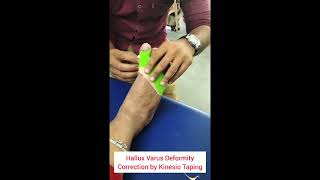 Hallux valgus deformity correction by kinsio taping by Sharda college of physiotherapySharda Campus [upl. by Eda719]