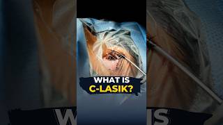 Do You Know What Is CLasik I CLasik Live Surgery [upl. by Charron678]