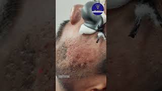 Laser Carbon peel Treatment for Dull Skin  Pigmented Acne scars amp uneven skin tone  DrNetiquots [upl. by Xuaeb924]