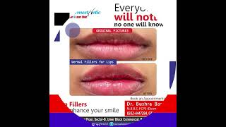 Lip Filler for Viscillious Lips 💋 by Dr Bushra Bashir [upl. by Suzanne]