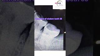 Painless EXTRACTION of Wisdom Tooth bhatiadentopulse toothpain extraction [upl. by Thgiwed]