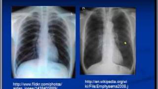 Chest xray interpretation COPD and Emphysema [upl. by Tearle]