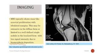 Pigmented Villonodular Synovitis [upl. by Hairahs]