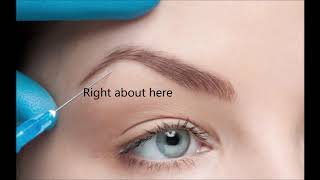 Dr Nino Kuzmar Performs Eyebrow Lift with Botox [upl. by Edda]