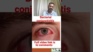 bacterial conjunctivitis [upl. by Hirza]