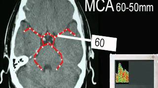 do neurology clinic edu test TCD 초음파뇌혈류 [upl. by Pammie]