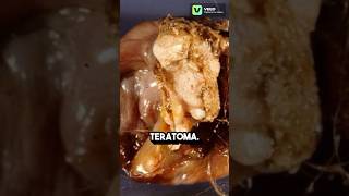 Apa itu Teratoma scaryfacts tumor horrorshorts scaryshorts [upl. by Kaela]