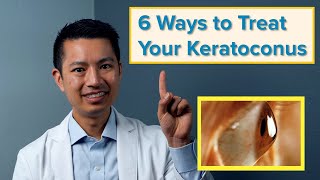 The 6 Best Ways to Treat Your Keratoconus [upl. by Magas675]