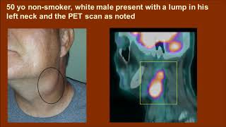 HPV and Oropharynx Part 2 [upl. by Heurlin]