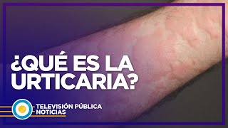 Qué es y cómo tratar la urticaria [upl. by Andres]