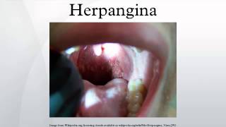 Herpangina [upl. by Toile]